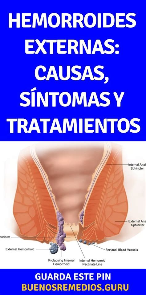 hemorroides por sexo anal|Hemorroides y otros trastornos anales